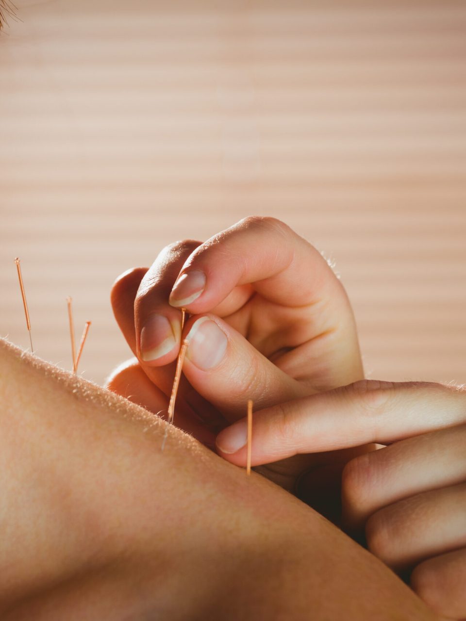 Young woman getting acupuncture treatment in therapy room Young woman getting acupuncture treatment in therapy room